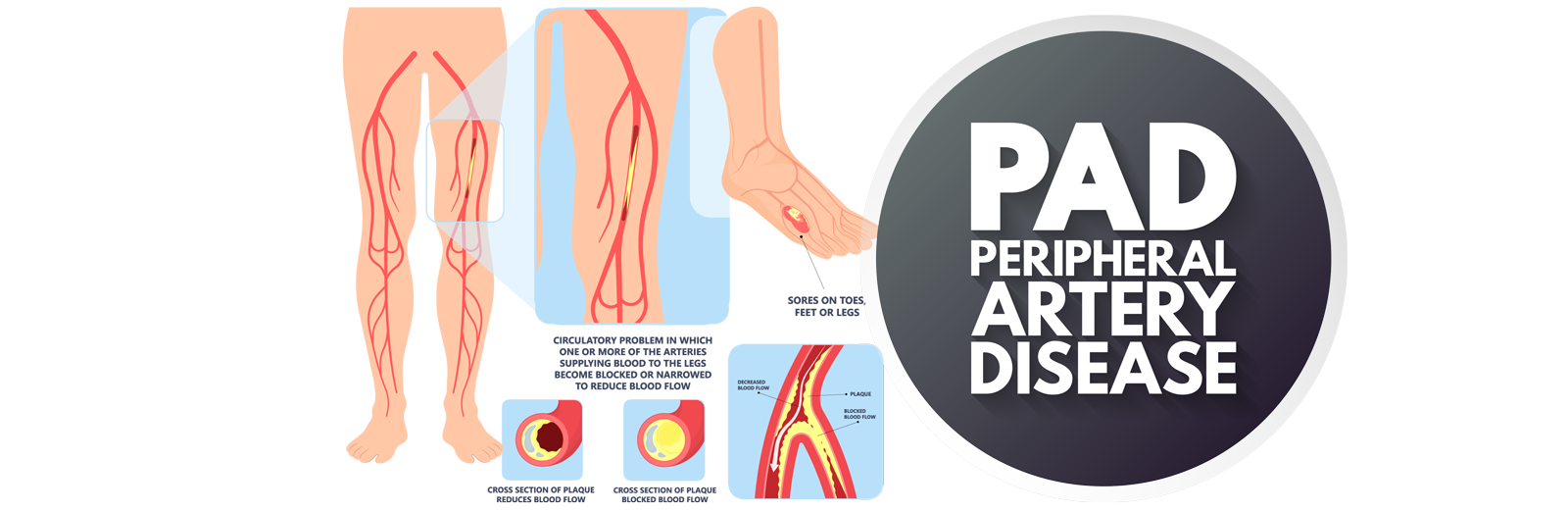 Diabetes PAD Questionnaire CV Experts Of Central Pennsylvania The