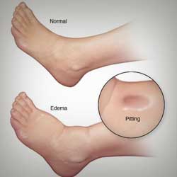 Swelling in legs or feet