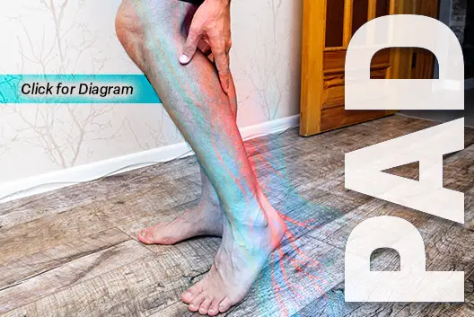 Peripheral Artery Disease